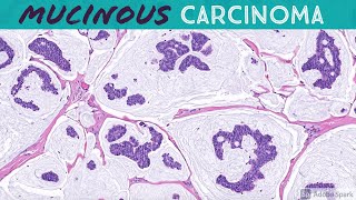 Primary Cutaneous Mucinous Carcinoma amp Endocrine MucinProducing Sweat Gland Carcinoma [upl. by Yrek]