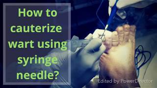 How to remove planter wart using syringe needle [upl. by Eimilb]