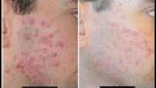 Acne Scars Acne 6 [upl. by Eiryt]