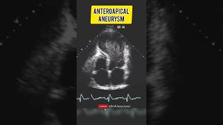 Large Anteroapical Aneurysm  Echocardiography For Beginners cardiology echocardiogram [upl. by Barri832]