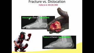 Midfoot Charcot Treatment Options and Considerations [upl. by Haliak356]