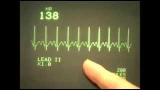 EKC ECG rhythms 1 Normal range of rhythms [upl. by Humfrey849]