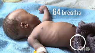 How to count respiration rate and notice chest indrawing in children [upl. by Pelletier]