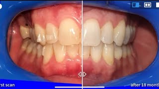 Invisalign treatment before and after with Virtual tracking time lapse [upl. by Koeninger693]