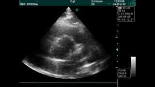 echocardiography doppler bicuspid aortawmv [upl. by Ikciv]