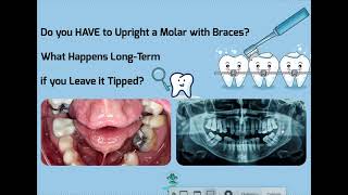 Do you HAVE to Upright a Tipped Molar Risks Benefits and Alternatives [upl. by Enajharas453]