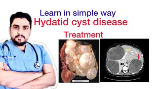 Hydatid cyst disease of liverTreatment [upl. by Sylvan883]