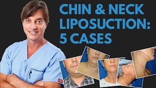 Liposuction for a Double Chin 5 Cases with Before amp After Photos [upl. by Marlin42]