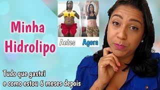 HIDROLIPO  VALORES E COMO ESTOU 6 MESES DEPOIS  Parte 3 [upl. by Epperson]