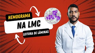 Hemograma Na Leucemia Mieloide Crônica  LMC [upl. by Nart]