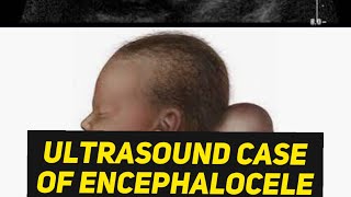 Encephalocele or Cystic Hygroma  Learn ultrasound [upl. by Idnir784]