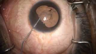 Viscodissection for Central Posterior Synechiae at the Time of Cataract Surgery [upl. by Ensoll174]