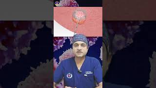 What is Radio Ablation Frequency RFAcancertreatment doctor [upl. by Herodias]