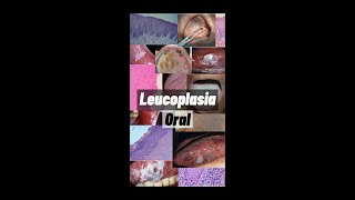 Leucoplasia Oral [upl. by Geraldina995]