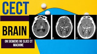 🧠HOW TO DO CECT BRAIN  CONTRAST CT BRAINHEAD SIEMENS 96 SLICE CT MACHINE 📊 [upl. by Ibby449]