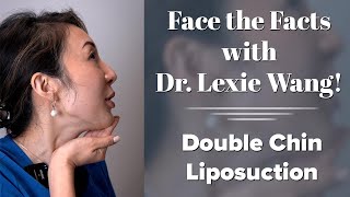 Lower Face amp Neck Submental Liposuction  Face the Facts with Dr Wang  West End Plastic Surgery [upl. by Crescentia]