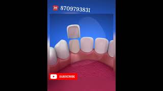 Dental Veneers Laminates for Bollywood Smile yt shorts dentalveneerssmile dentist in Patna [upl. by Gaivn848]