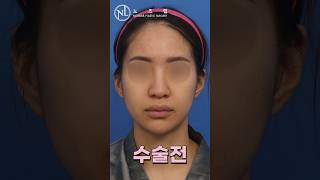 노즈랩의원 수술전후 beforeandafter 코성형 비개방코성형 noselab [upl. by Idnil39]