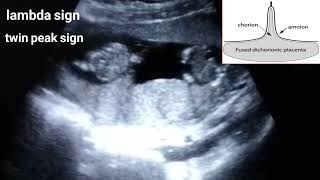 Dichorionic diamniotic twin pregnancylambda sign [upl. by Salangi]