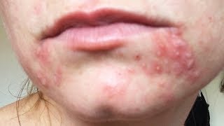 Dealing with Recurring Perioral Dermatitis [upl. by Mala]