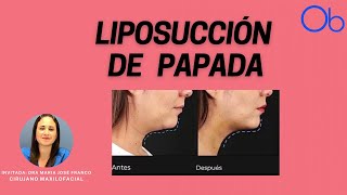 Liposucción de papada [upl. by Petulah]