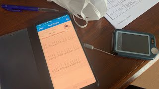 Extrasystoles arythmie Enregistreur d’événement VS smartwatch [upl. by Chiang336]