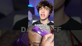 How to get rid of dandruff 😱🤝 [upl. by Suolekcin]