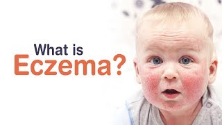 What is Eczema  ECZEMA IN BABIES  CHILDCARE  SKIN CARE [upl. by Annawoj]