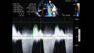 Mitral Regurgitation and PISA calculation [upl. by Yrral]