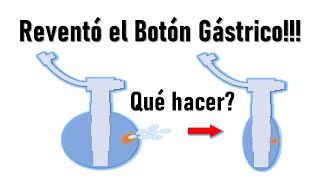 😱SE ROMPIÓ el botón de Gastrostomía😱 Cómo SOLUCIONARLO FÁCIL💚💚 [upl. by Eniowtna]