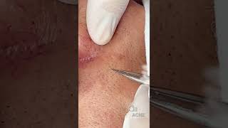 Relieve Stress with a Relaxing Pimple Extraction Video [upl. by Violette343]