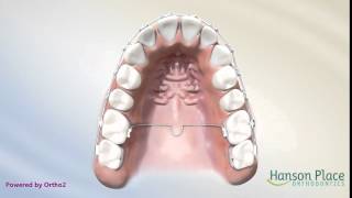 Trans Palatal Arch [upl. by Pierrepont731]