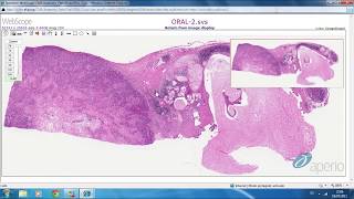 Mucoepidermoid Carcinoma Salivary gland tumor 🔬salivarygland cancer tumors [upl. by Reteid709]