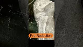 Close reduction of proximal epiphyseal slip of tibia in kids  SALTERHARRIS type 1 [upl. by Aleciram]