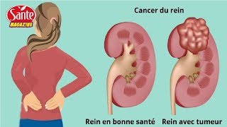 7 signes qu’un cancer se développe dans vos reins [upl. by Tann340]