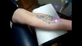 Laser Tattoo Removal [upl. by Asiela]