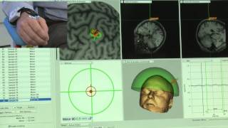 TMS Current Direction Control Over Targeted Brain Area [upl. by Sinnard]