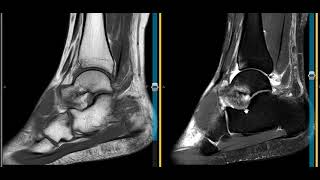 Ankle pain secondary to sinus tarsi and and spring ligament injuries [upl. by Notaek]