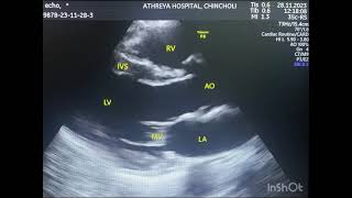 2D Echo and Cardiac Doppler [upl. by Quincey104]