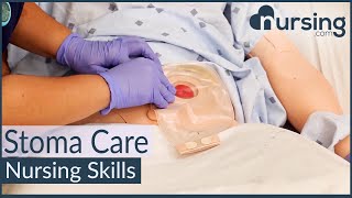 Stoma Care Changing a Colostomy Bag Nursing Skills [upl. by Harbot]