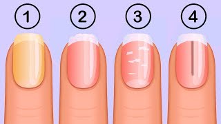 5 Things Your Nails Can Tell You About Your Health [upl. by Ettenwad]