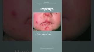 Impetigo  What is it and what is the treatment shorts [upl. by Town]