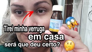 Como tirar verruga em casaEu tirei a minha [upl. by Noslrac121]