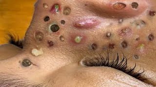 Loan Nguyen Acne Treatment 31d [upl. by Starla]