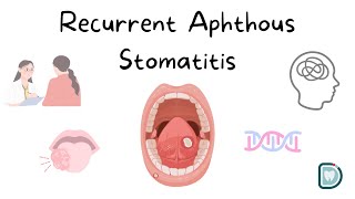 Understanding Recurrent Aphthous Stomatitis RAS or Oral Aphthous Ulcers [upl. by Anneuq]