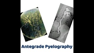 antegrade Pyelography [upl. by Enaamuj61]