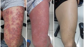 Dealing with Itching of Psoriasis [upl. by Hamilah633]