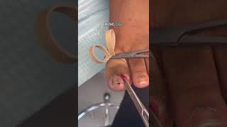 SO SATISFYING Follow us for more themedipedispa 🦶🏼 medipedi pedicure ingrown houstontx [upl. by Eidda]