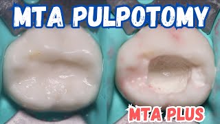 MTA PULPOTOMY 🟡 Pulpotomy with MTA PLUS 🟢 Step By Step [upl. by Abbey571]