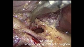 laparoscopic cholecystectomy [upl. by Collbaith]